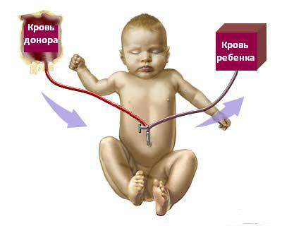 переливание крови ребенку