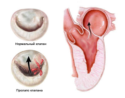 пролапс клапана сердца