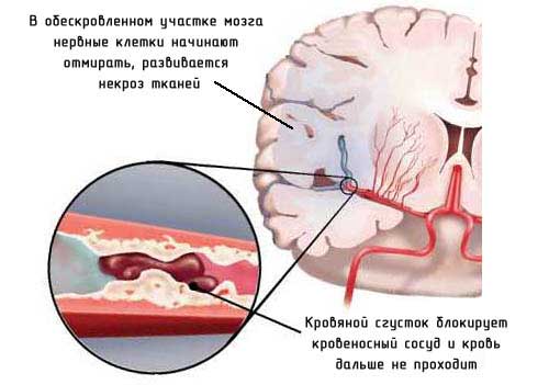 после инсульта