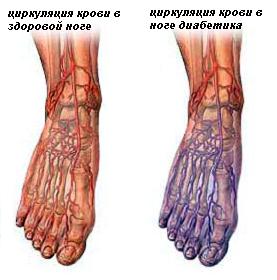 Циркуляция крови в ногах диабетика