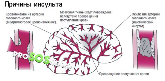 причины инсульта