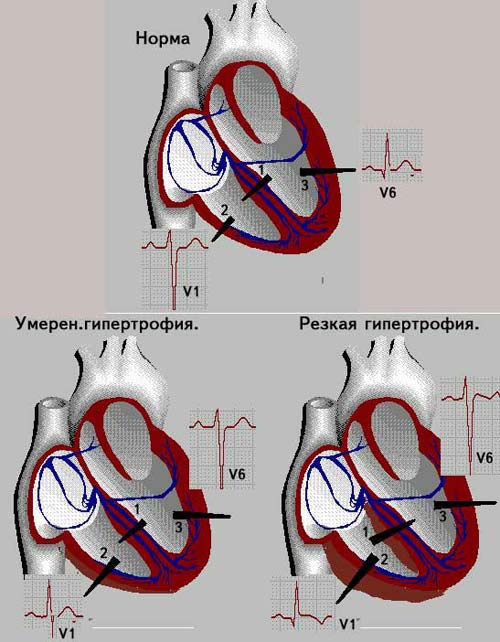 признаки гипертрофии правого желудочк