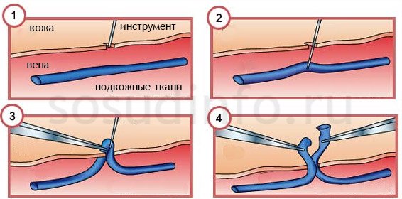 Традиционная флебэктомия крючком