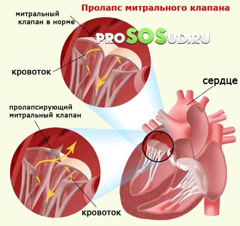 пролапс клапана сердца