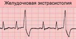 проявление ЖЭС на ЭКГ