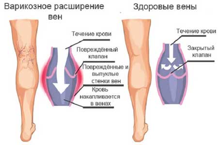 проявления варикоза