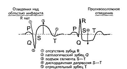 расшифровка кардиограммы