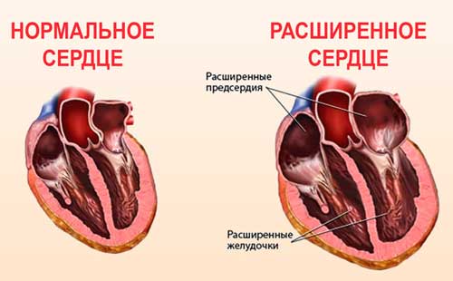 расширенное сердце
