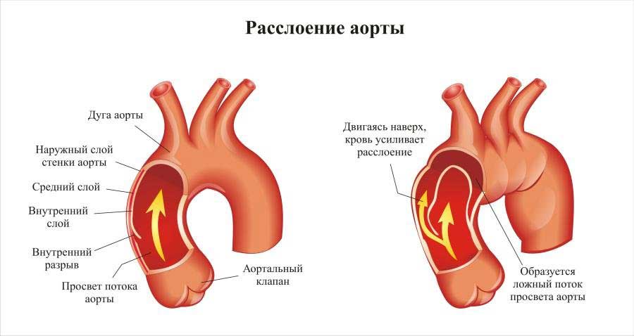 расслоение аорты