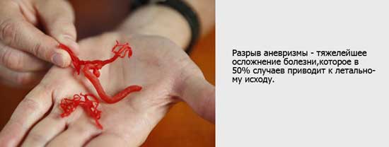 разрыв аневризмы