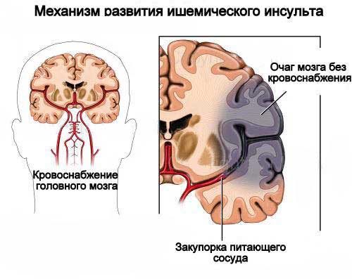 Развитие ишемии