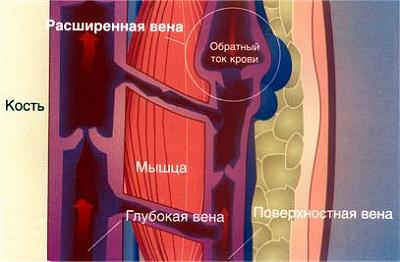расширенаня вена