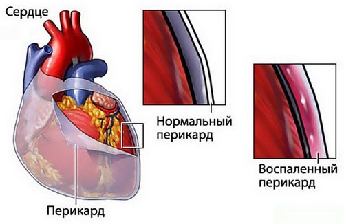воспаленный перикард