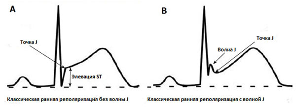 результат ЭКГ