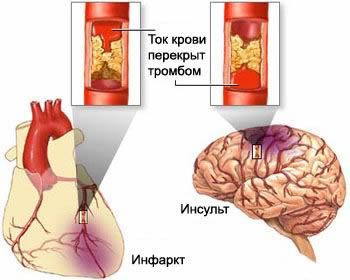 риски при атеросклерозе