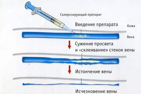 склеротерапия