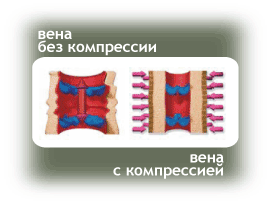 сдавливание вены 