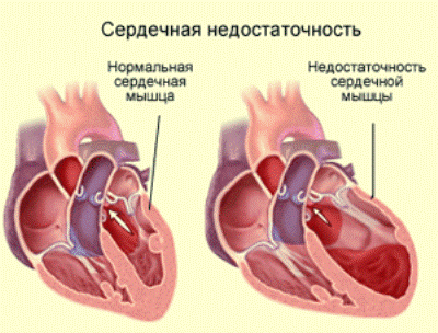 сердечная недостаточность