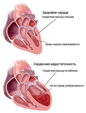 сердечная недостаточность