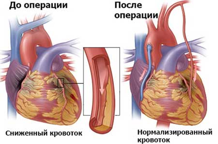 шунтирование сердца