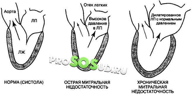 виды митральной недостаточности