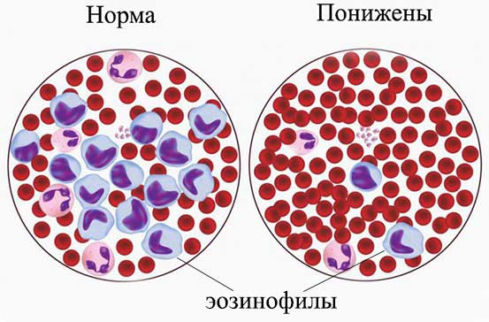 снижение эозинофилов