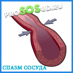 спазм сосуда