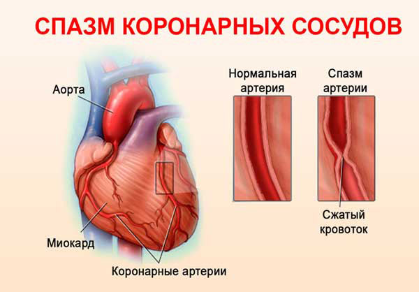спазм коронарных сосудов