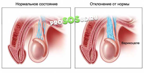 сравнение здоровых яичек и с варикозом