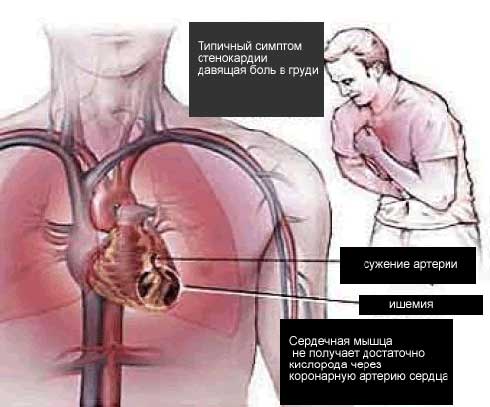 стенокардия