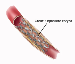в просвете сосуда