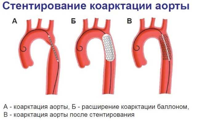 стентирование коарктации аорты