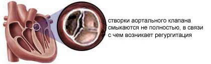 створки аортального клапана