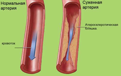 сужение сосудов