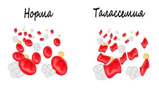 талассемия