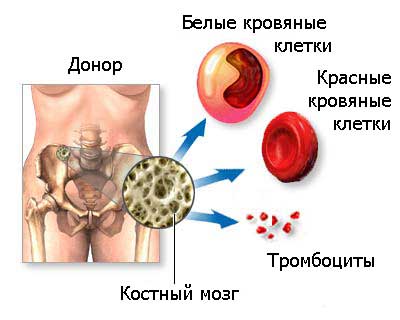 трансплантация костного мозга