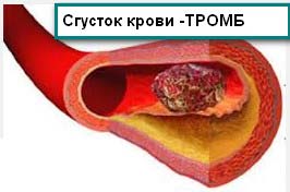 тромб в сосудах