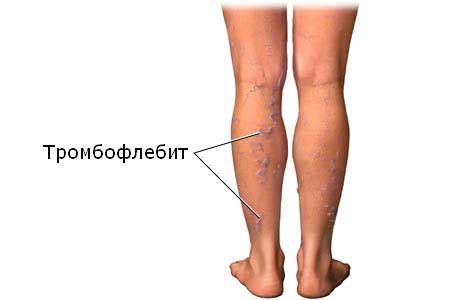 тромбофлебит на ногах