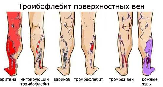 тромбофлебит вен