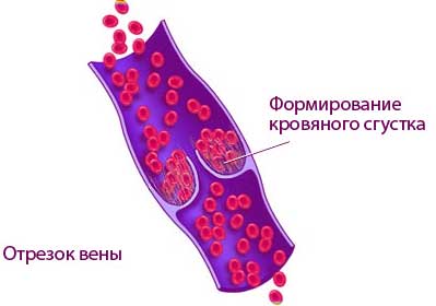 тромбоз вен