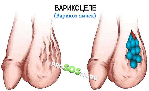 варикоцеле на яичках