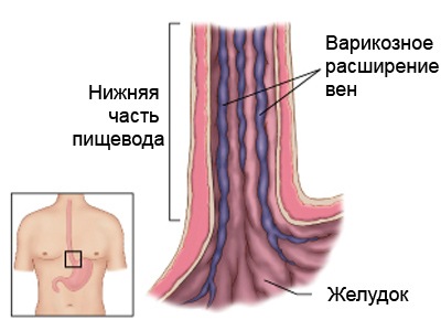 варикоз пищевода