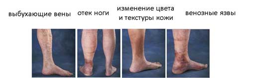 венозная недостаточность