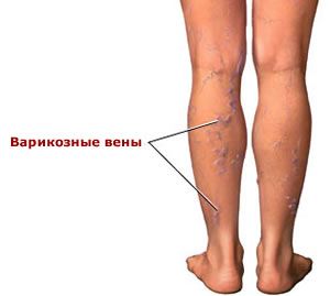 варикоз на ногах