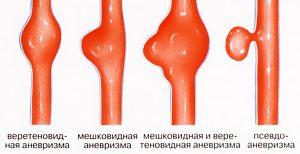 виды аневризм