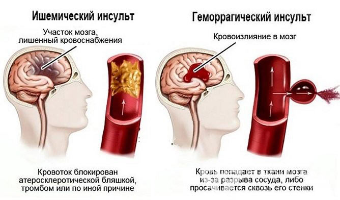 виды инсульта