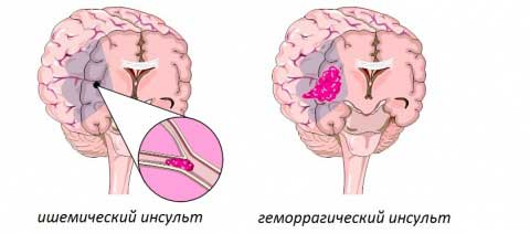 виды инсультов