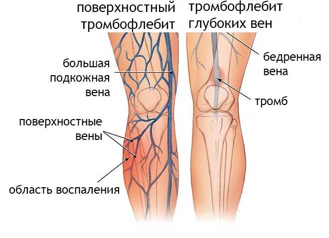 виды тромбофлебита