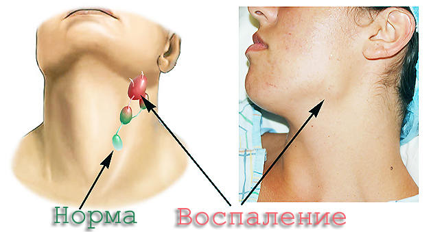 воспаления лимфоузлов