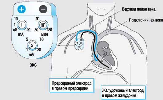 временный кардиостимулятор